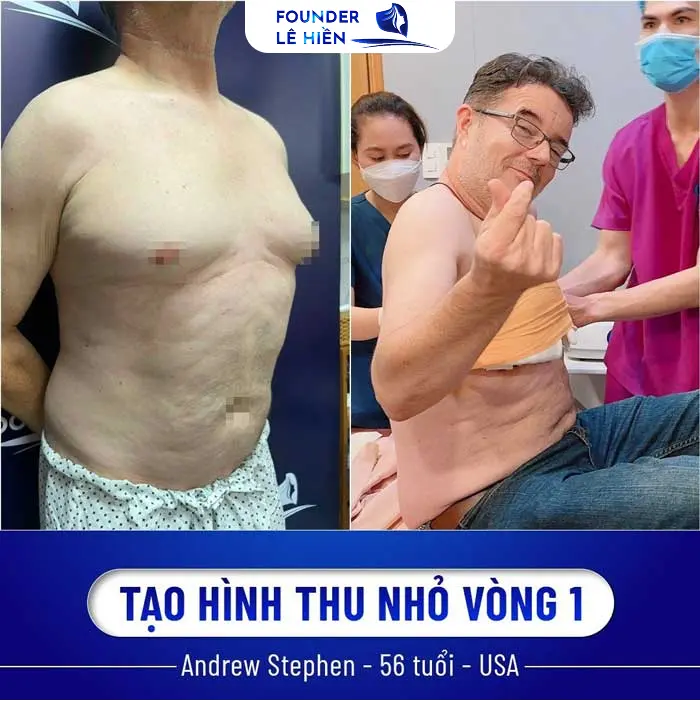 nữ hóa tuyến vú ở nam giới