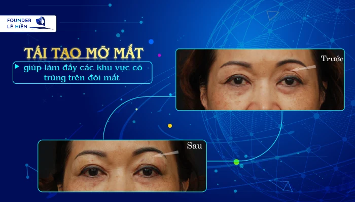 Tái tạo mỡ mắt