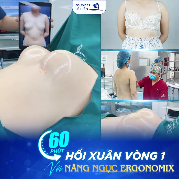 Nâng ngực Ergonomix