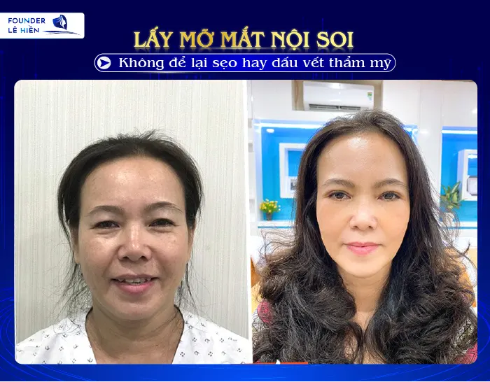 lấy mỡ mắt nội soi