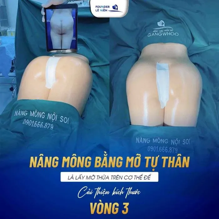 Nâng mông bằng mỡ tự thân