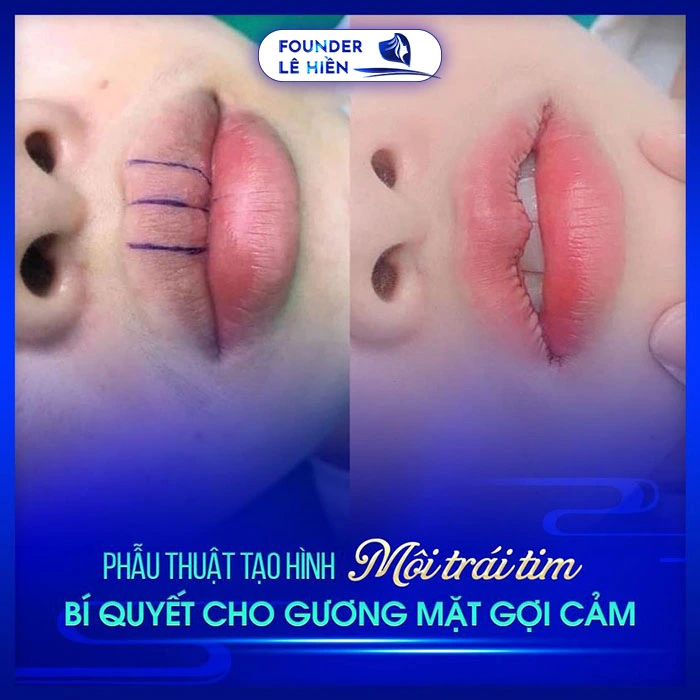 Đôi môi hình trái tim tượng trưng cho vẻ đẹp lãng mạn và quyến rũ