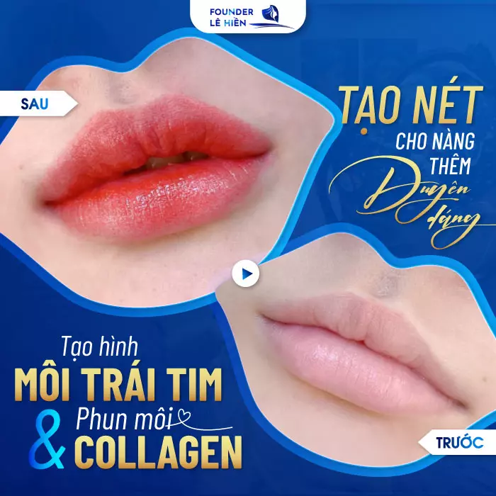 Môi đẹp hơn “ngàn lần” khi kết hợp tạo hình môi trái tim với phun môi Collagen 