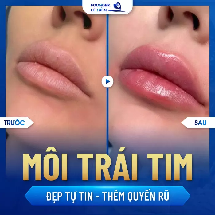 Tạo hình môi trái tim phù hợp với nhiều đối tượng khách hàng