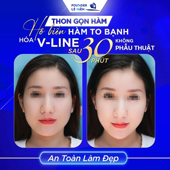 Thon Gọn Góc Hàm Không "Dao Kéo" - Khuôn Mặt Đẹp Chuẩn V-Line 3 Để sở hữu góc hàm thon gọn mà không cần “dao kéo”, bạn có thể tham khảo phương pháp tiêm thon gọn hàm.