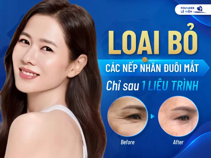 Xóa Nhăn Đuôi Mắt - Đẩy Lùi Dấu Hiệu Lão Hóa, Duy Trì Vẻ Đẹp Tươi Trẻ 2 Công nghệ cao kết hợp với bác sĩ giỏi sẽ giúp bạn loại bỏ hết các vết chân chim ở đuôi mắt.