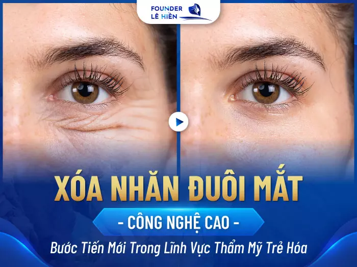 Xóa Nhăn Đuôi Mắt - Đẩy Lùi Dấu Hiệu Lão Hóa, Duy Trì Vẻ Đẹp Tươi Trẻ 4 Xóa nhăn đuôi mắt không can thiệp “dao kéo”được thực hiện nhanh chóng