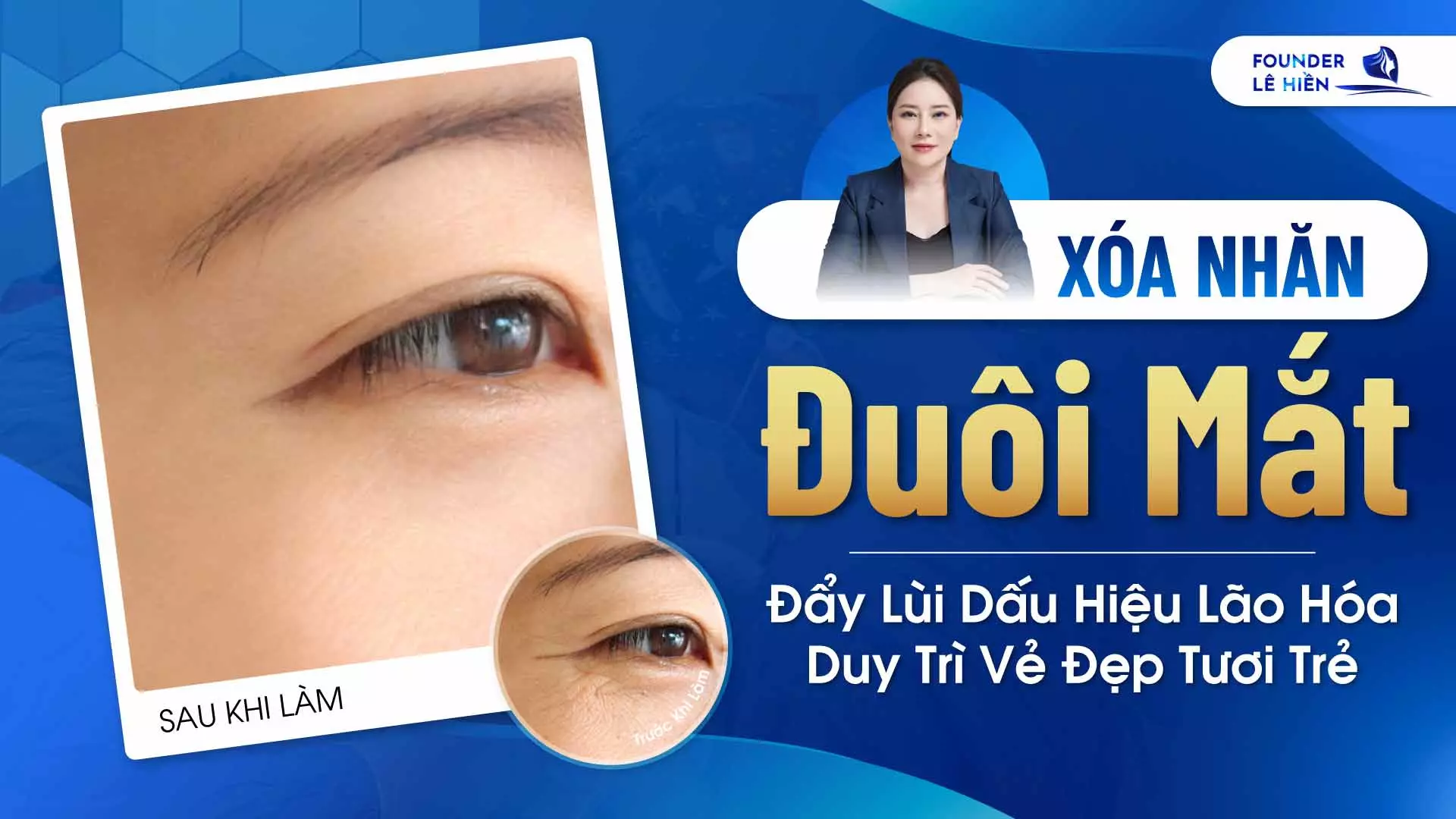 Xóa Nhăn Đuôi Mắt - Đẩy Lùi Dấu Hiệu Lão Hóa, Duy Trì Vẻ Đẹp Tươi Trẻ 1 Đôi mắt là cửa sổ tâm hồn, một đôi mắt đầy vết chân chim sẽ khiến bạn trông kém sắc và già đi trước tuổi