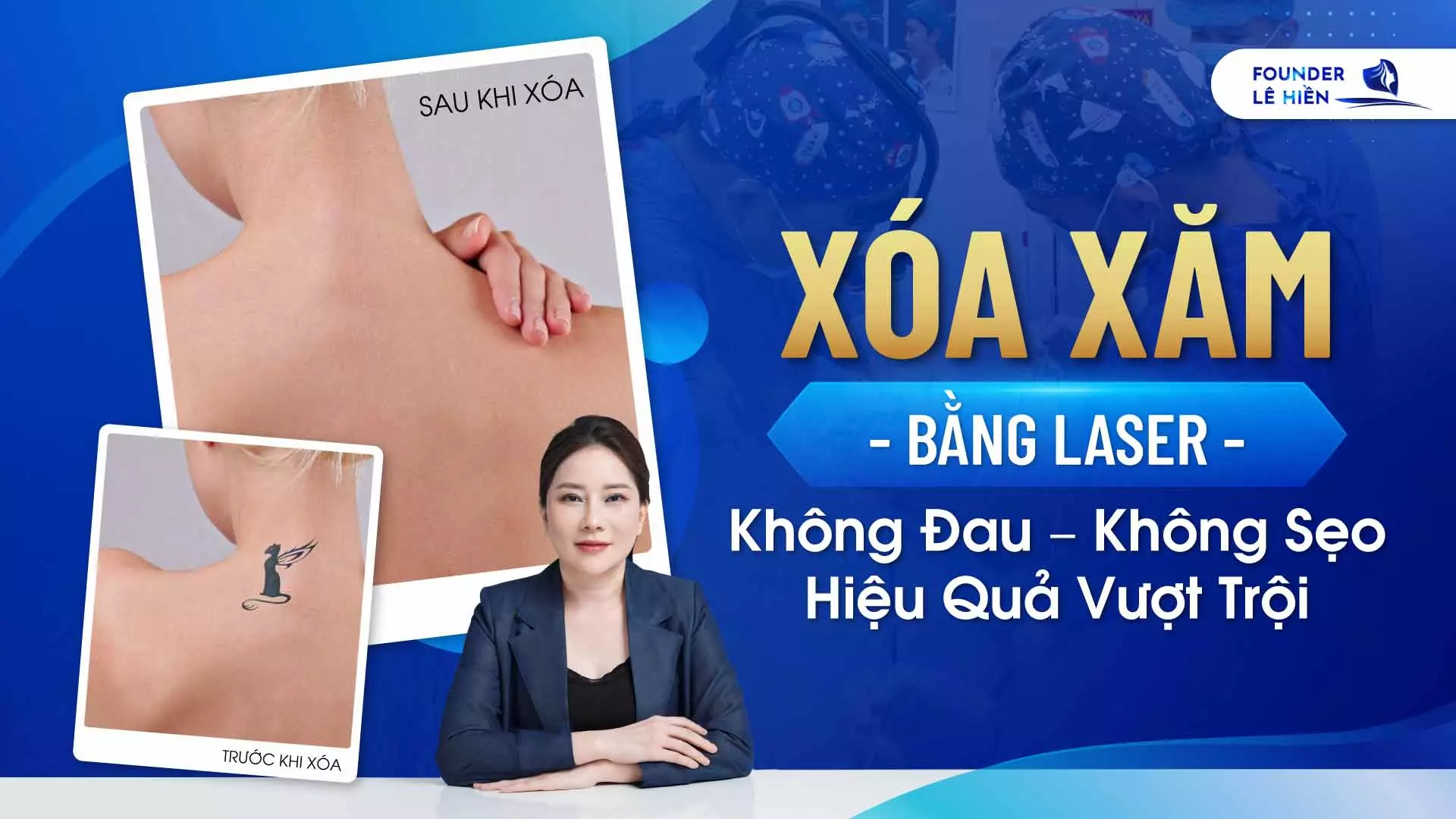 xoa xam bang laser 1