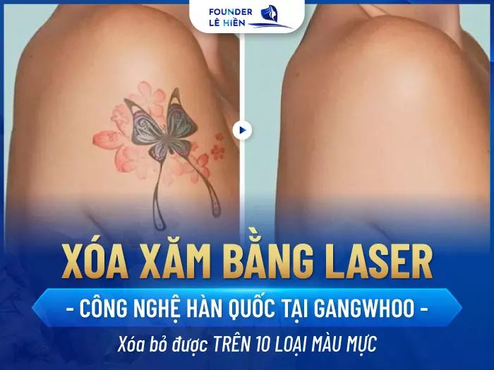 Xóa xăm băng công nghệ Laser mang lại hiệu quả nhanh chóng và an toàn với mọi làn da