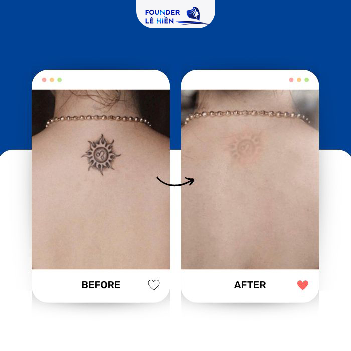 Hiệu quả giữa mỗi lần xóa xăm sẽ khác nhau ở mỗi người