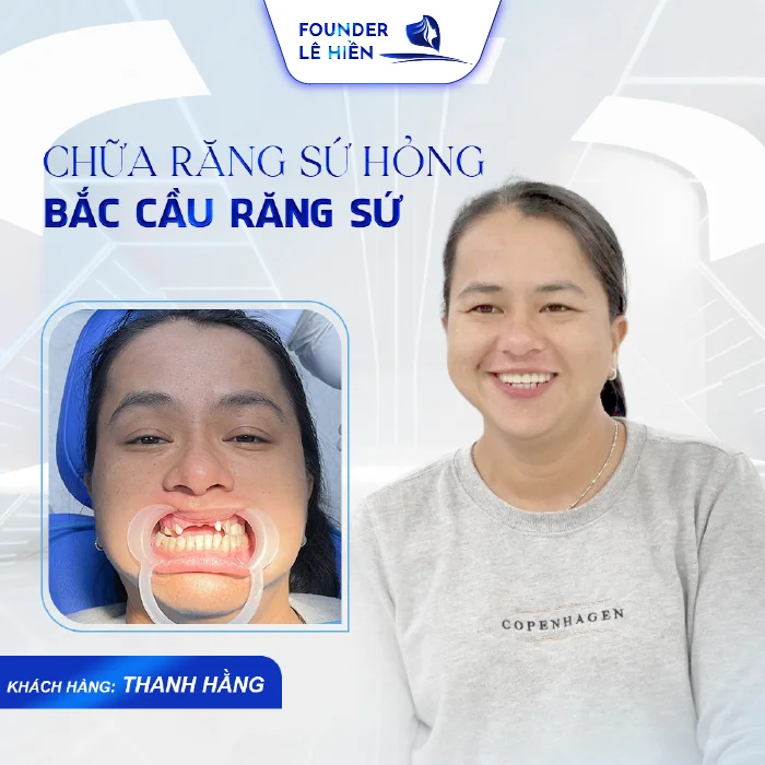 Bọc răng sứ