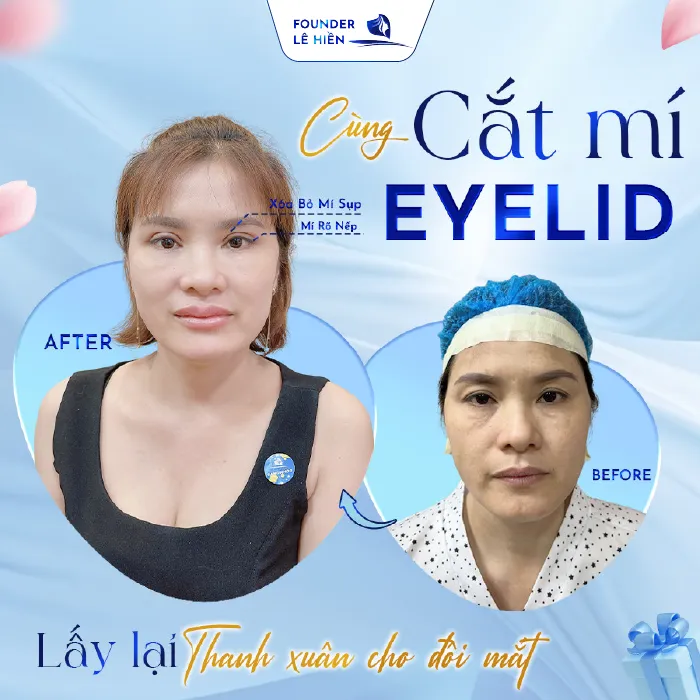 Cắt mí Eyelid