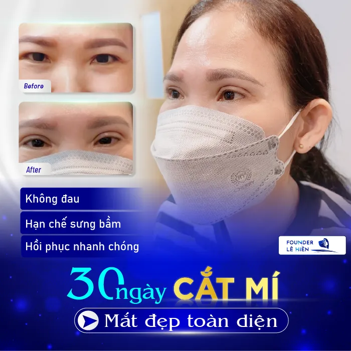 Cắt mí Eyelid