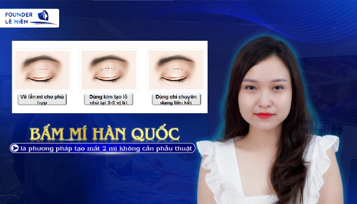 Bấm mí Hàn Quốc