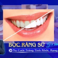 Bọc Răng Sứ-01