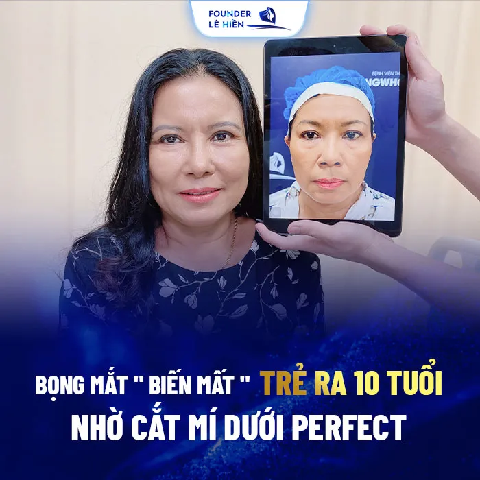 Cắt mí dưới Perfect