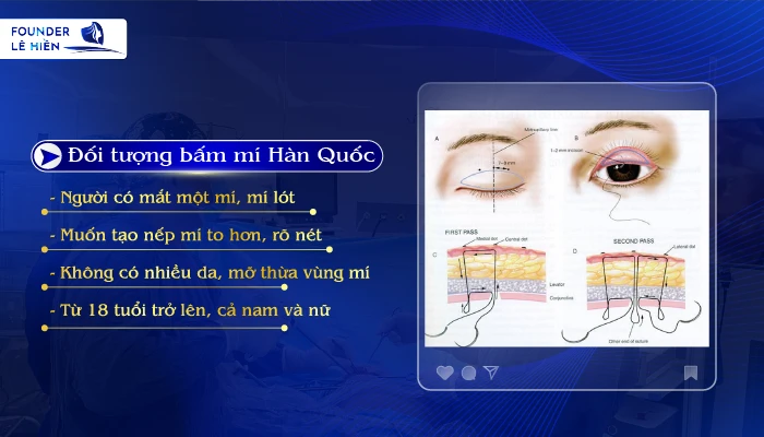 Bấm mí Hàn Quốc