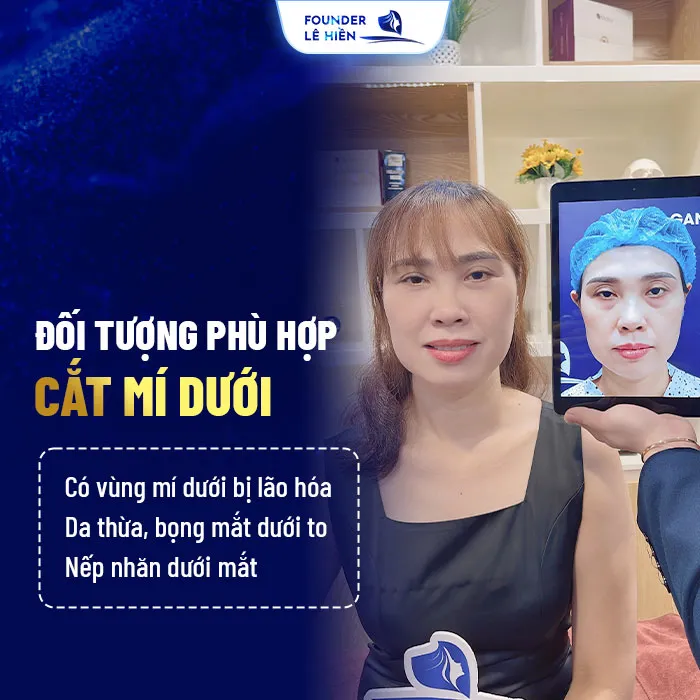 Cắt mí dưới Perfect