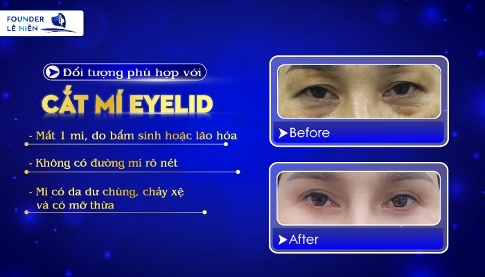 Cắt mí Eyelid