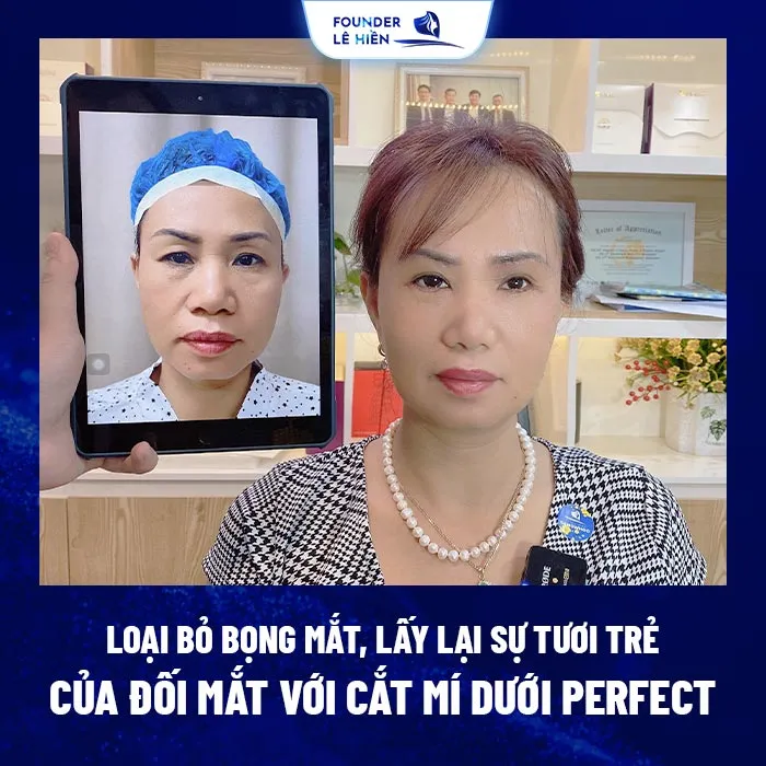 Cắt mí dưới Perfect