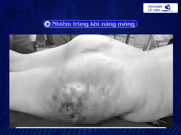 nâng mông có biến chứng không