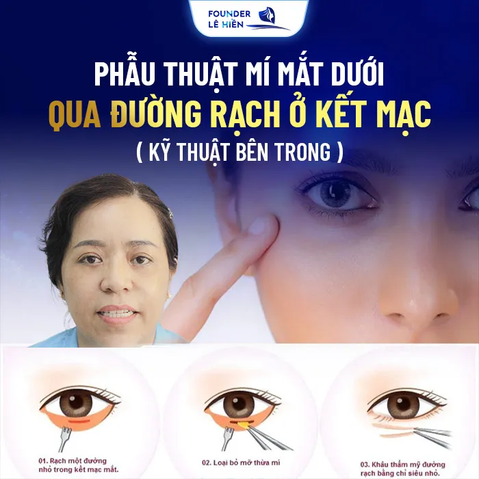 Cắt mí dưới Perfect