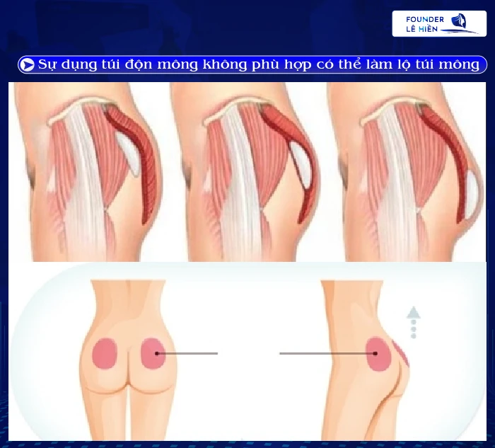 nâng mông có biến chứng không