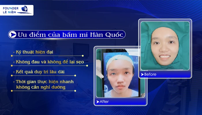 Bấm mí Hàn Quốc