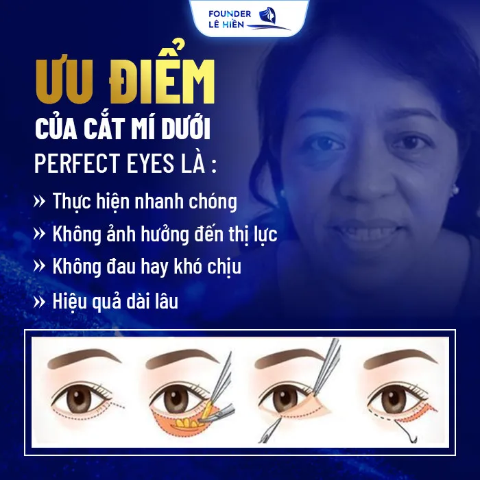 Cắt mí dưới Perfect