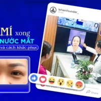 Nguyên nhân cắt mí xong bị chảy nước mắt và cách khắc phục hiệu quả cat-mi-xong-bi-chay-nuoc-mat