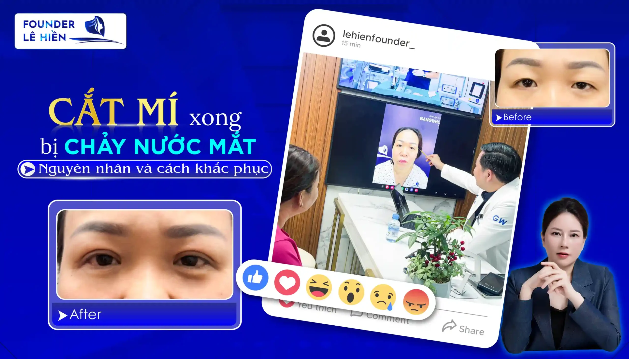 Nguyên nhân cắt mí xong bị chảy nước mắt và cách khắc phục hiệu quả 1 Nguyên nhân cắt mí xong bị chảy nước mắt và cách khắc phục hiệu quả