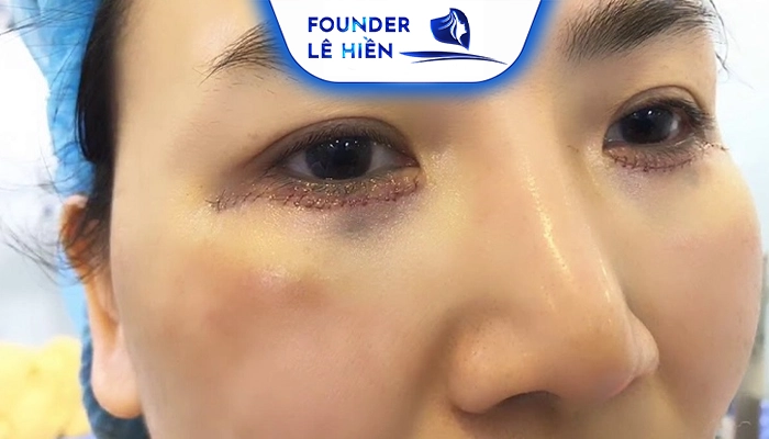 Nguyên nhân cắt mí xong bị chảy nước mắt và cách khắc phục hiệu quả 3 Có thể bị chảy nước mắt do tác dụng phụ của một số loại thuốc