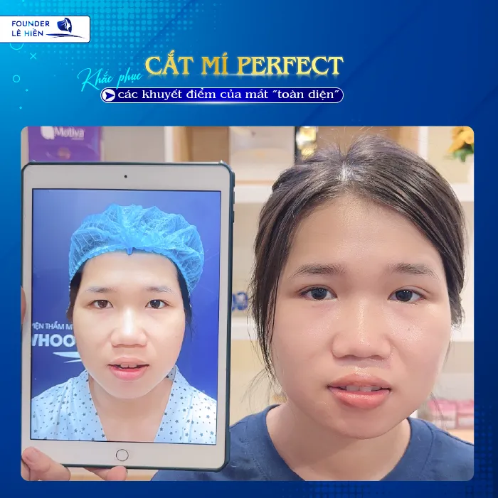 Cắt Mí Perfect 