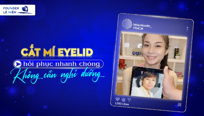 Cắt mí Eyelid