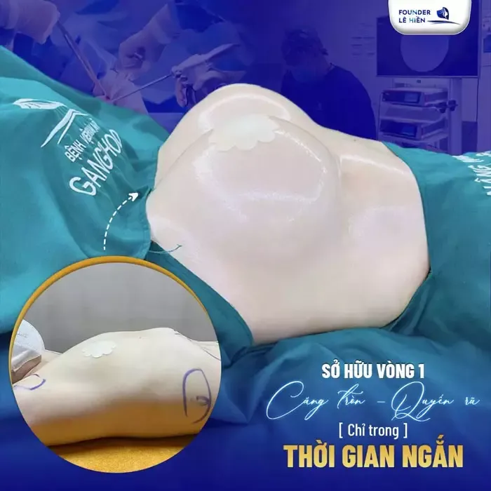 Nâng ngực bằng chất làm đầy