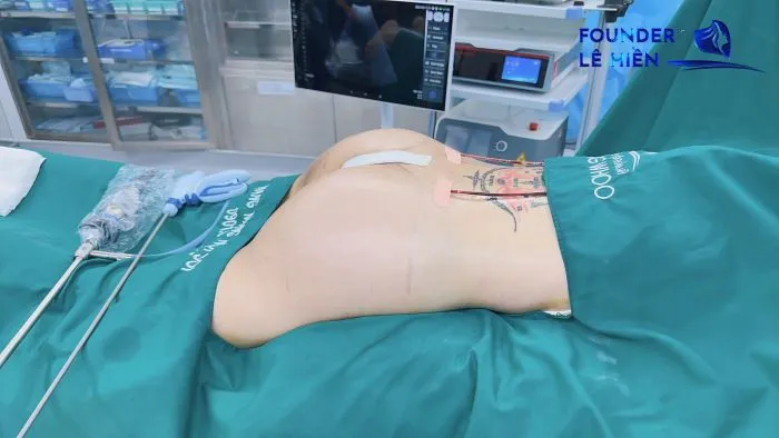 nâng mông có biến chứng không