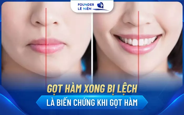 Những Điều Cần Biết Khi Phẫu Thuật Gọt Hàm