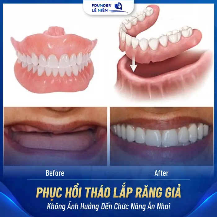 Phục hồi tháo lắp răng giả