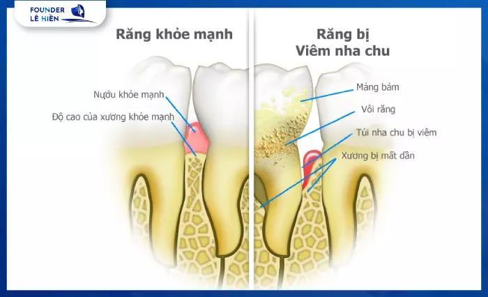 Nạo túi nha chu