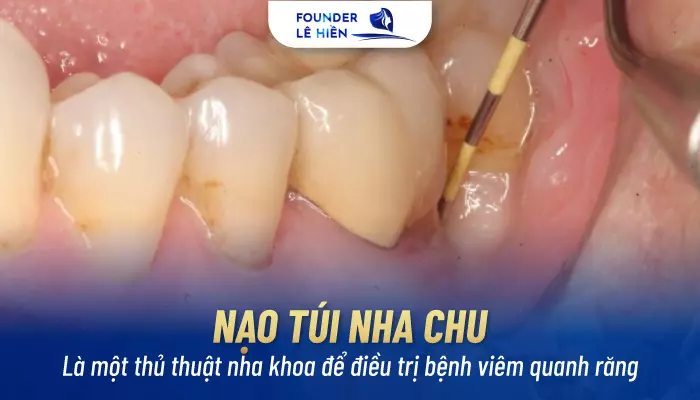 Nạo túi nha chu