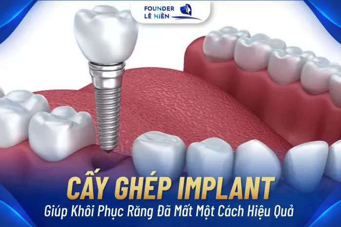 Cấy ghép Implant