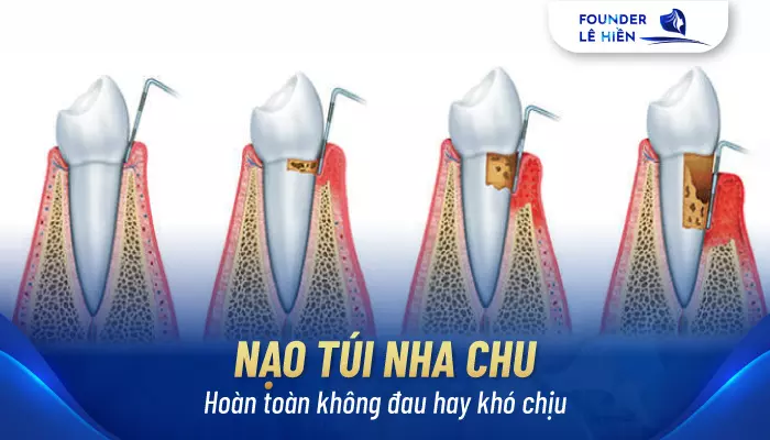 Nạo túi nha chu