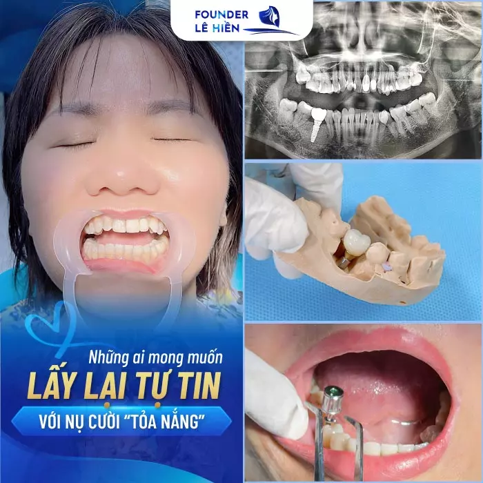 Cấy ghép Implant