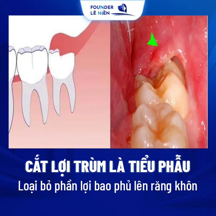 Cắt lợi trùm là một tiểu phẫu trong nha khoa