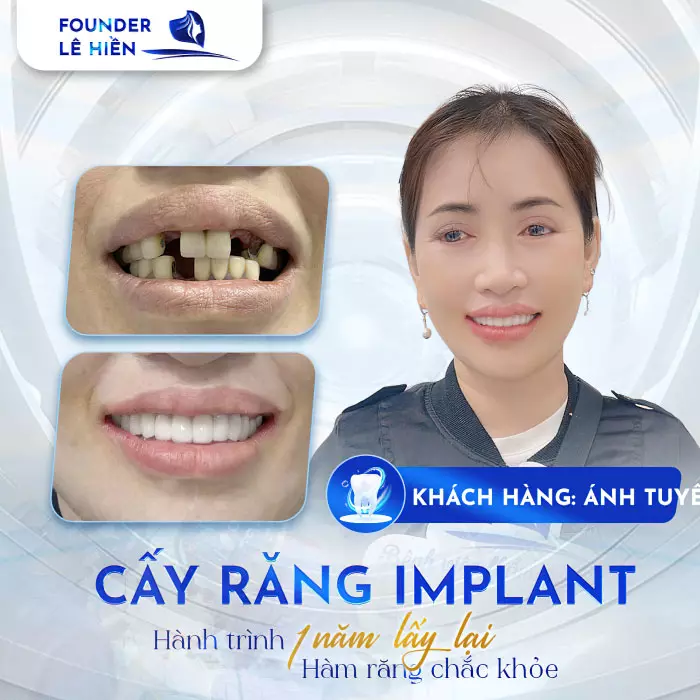 Cấy ghép Implant