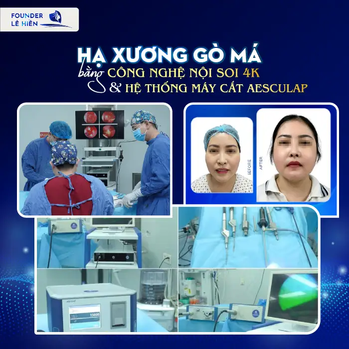 Hạ Gò Má Ở Đâu Đẹp