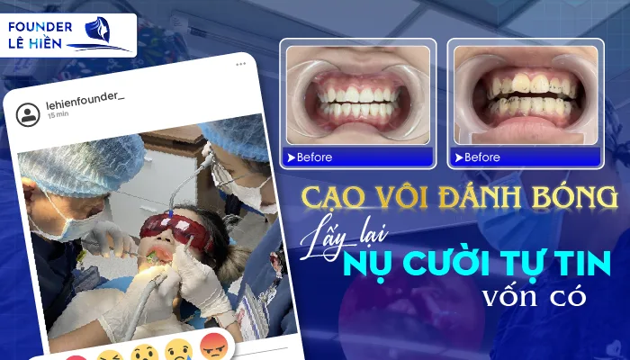 Cạo Vôi Răng