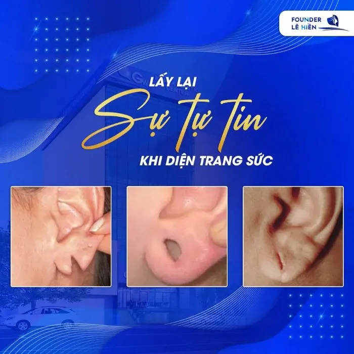 Sửa khuyên tai rộng