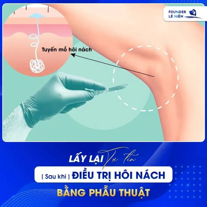 Điều trị hôi nách nách phẫu thuật